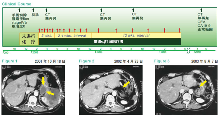 日本免疫細胞治療(瀨田診所)：胰腺癌，男，70歲