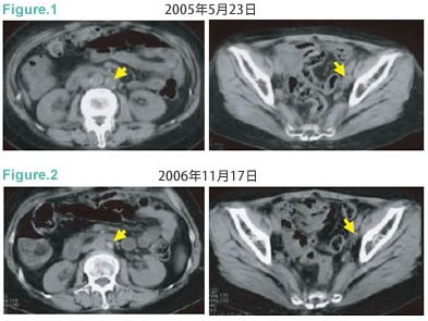 子宮內膜癌復發伴隨遠處轉移案例圖1