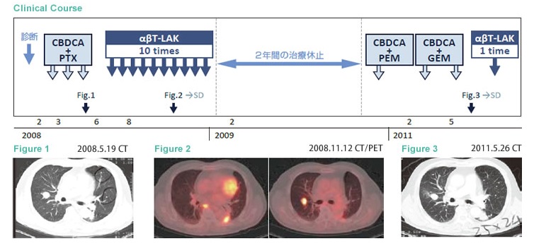 αβT細胞治療維持三年穩定狀態的肺腺癌案例1