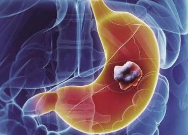 胃癌的腹腔鏡手術 - 現狀和未來進展